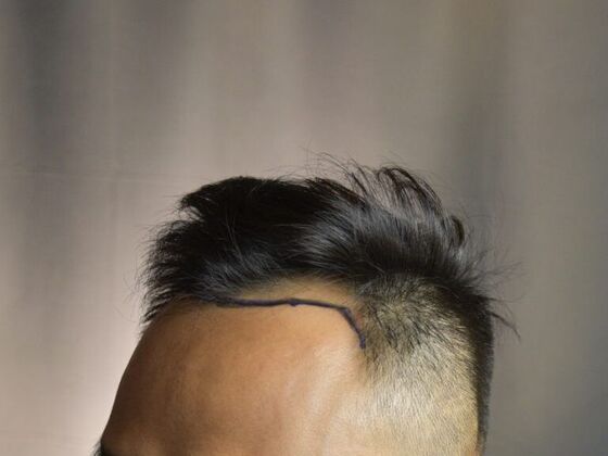 Before FUE Hair Restoration: Case 18's procedure