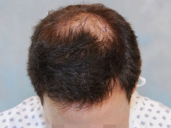Before Hair Transplant
